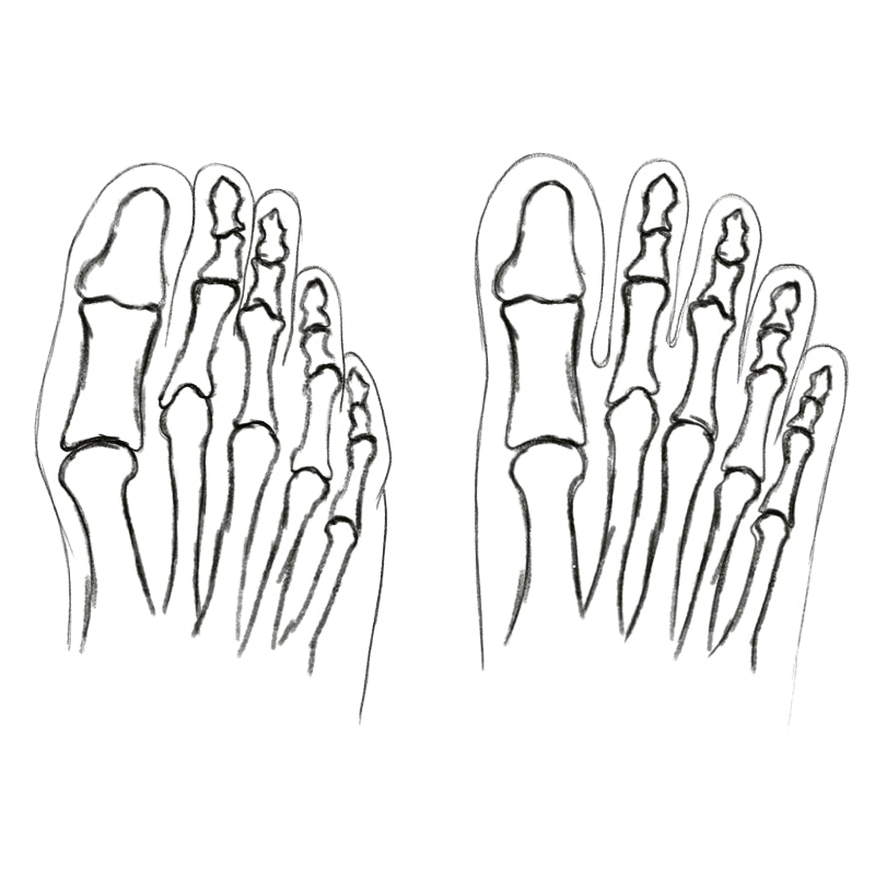 Bunions
