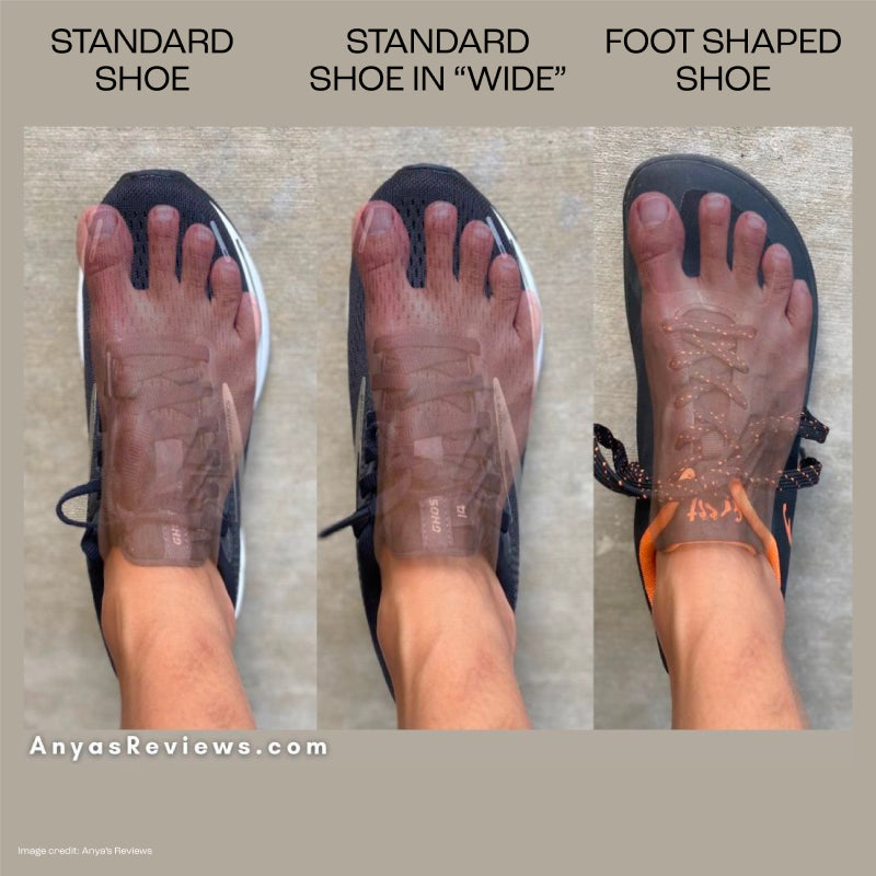 Bunions