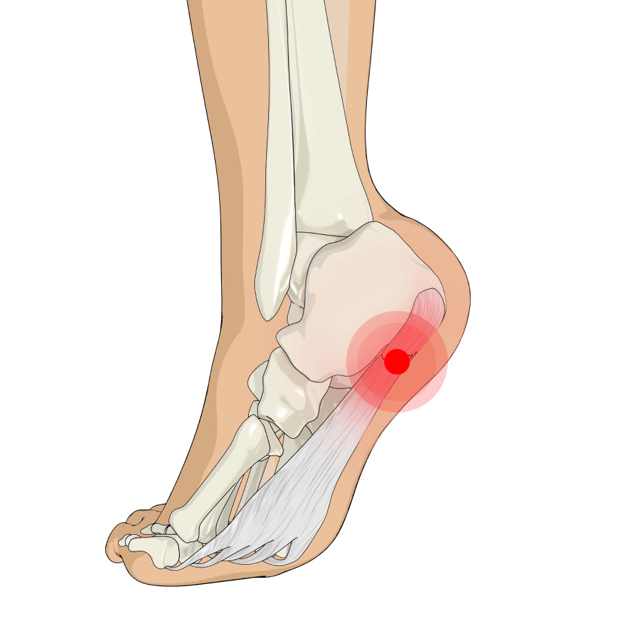 Plantar Fasciitis